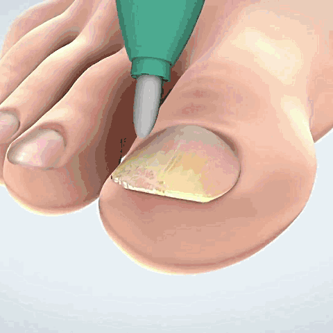 ⭐TRATAMIENTO PARA HONGOS SEVEN DAYS NAIL FUNGUS👨⚕️