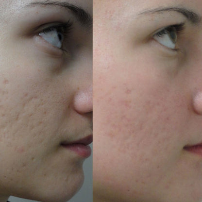 🔥DERMAROLLER: EL RODILLO ANTIARRUGAS Y MARCAS FACIALES🔥